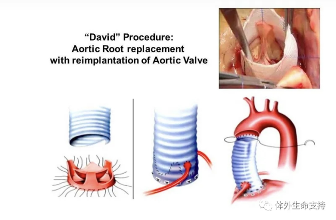 David手术助年轻马凡综合征患者绝境重生