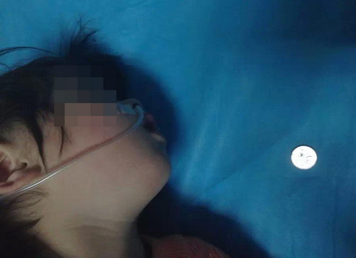 幼儿误吞硬币 唐少波主任内镜巧取食道异物