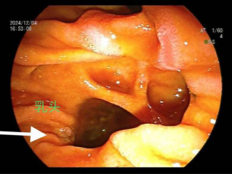 高难度ERCP取石—— 十二指肠乳头藏匿“隐秘角落” 多发憩室让取石之路“荆棘丛生”