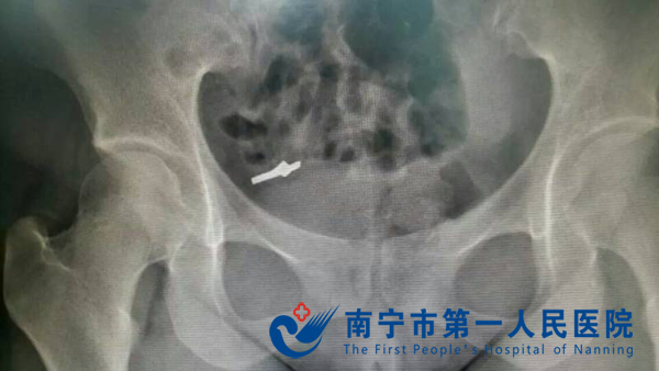 女子误吞求婚蛋糕内戒指 耳鼻喉科医师冷静解决