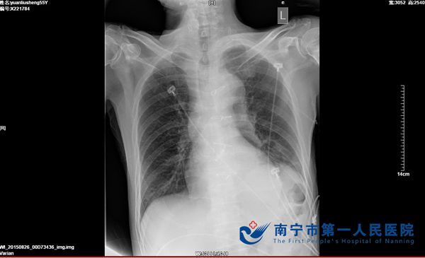 多学科协助显神威，“轻松”搞定气管狭窄