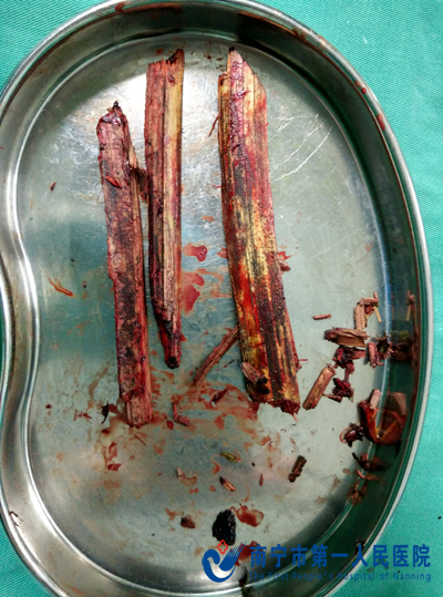 小男孩山坡坠落竹片从颈部贯穿头顶 我院小儿外科医生妙手取出