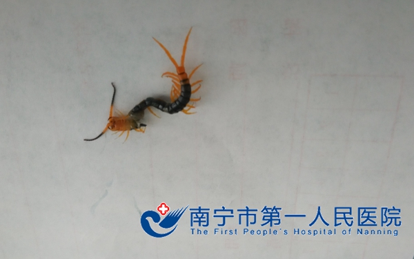 我院耳鼻喉科从患者耳朵巧取活蜈蚣