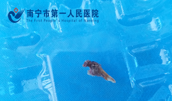 呼吸内科气管镜下巧取支气管异物