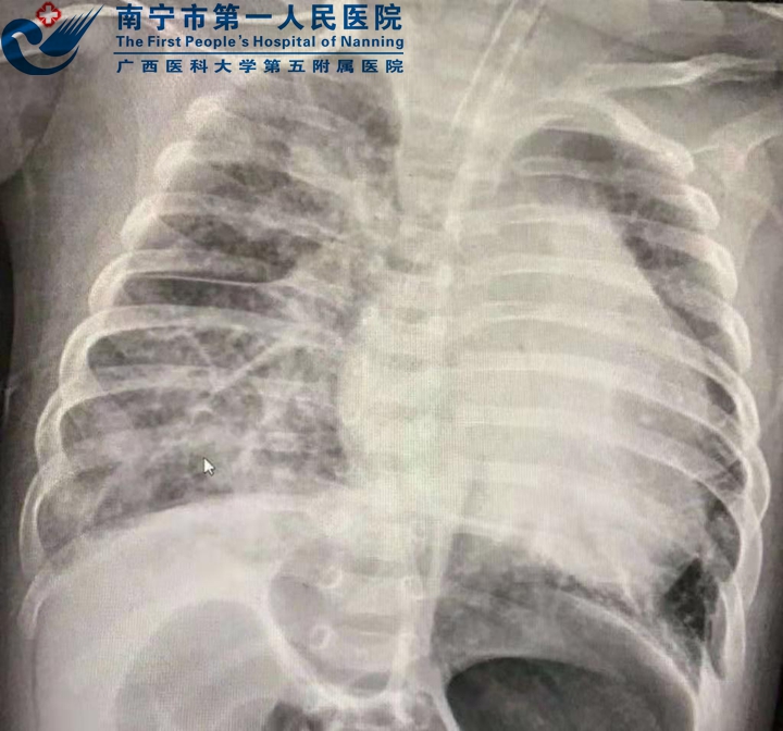 22次病危、22次大抢救！医护人员不放弃，7个月大宝宝终于出院了！