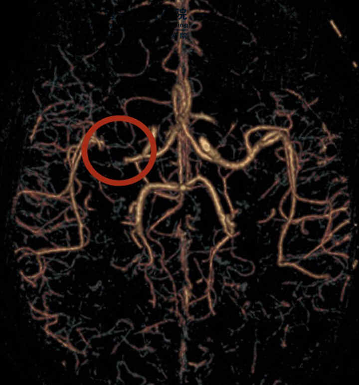 CTA提示右侧大脑中动脉重度狭窄（红色圆圈所示）_副本.jpg