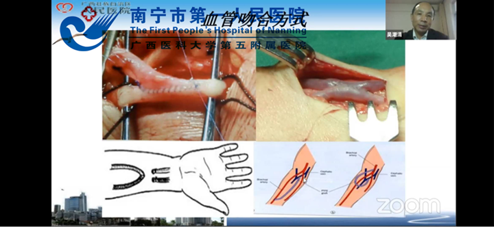 南宁市血液净化质量控制研讨会暨血管通路维护 线上学习班圆满完成