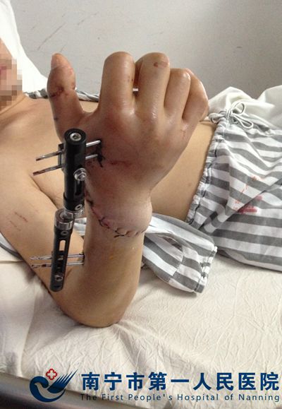 我院骨科一病区成功救治一例断腕患者