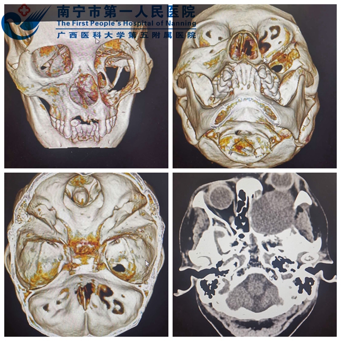 利用数字化3D打印技术为患者重塑美丽