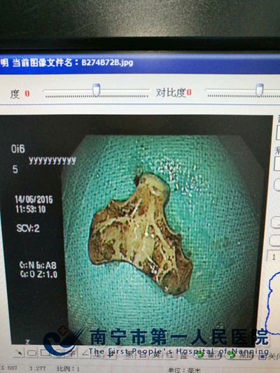 我院消化内科肠镜下巧取肠腔异物