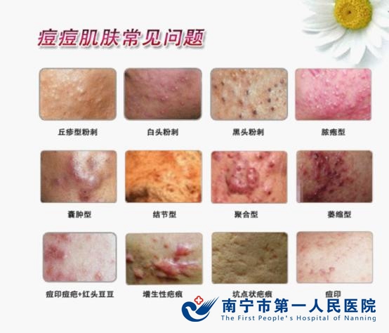 关注“5、25全国护肤日”为您传授“战痘”技巧