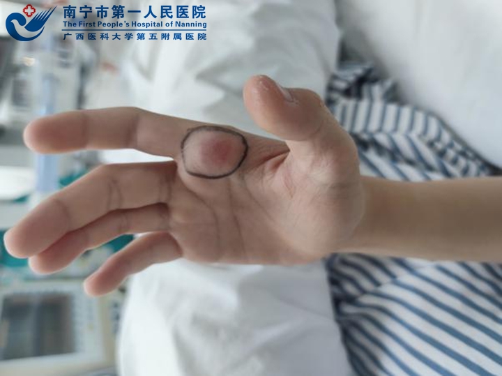 我院成功开展第一例海绵状血管瘤的介入治疗