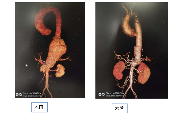 精准拆除体内“不定时炸弹” ——我院率先在广西区内独立开展胸腹主动脉瘤人工血管替换手术