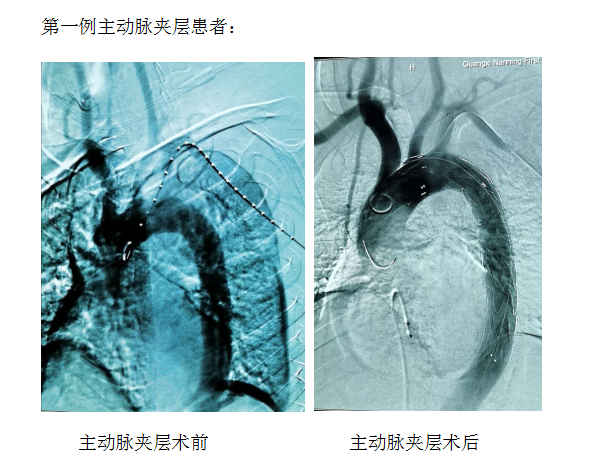 不畏艰险！心血管内科为两例主动脉疾病患者成功“拆弹”