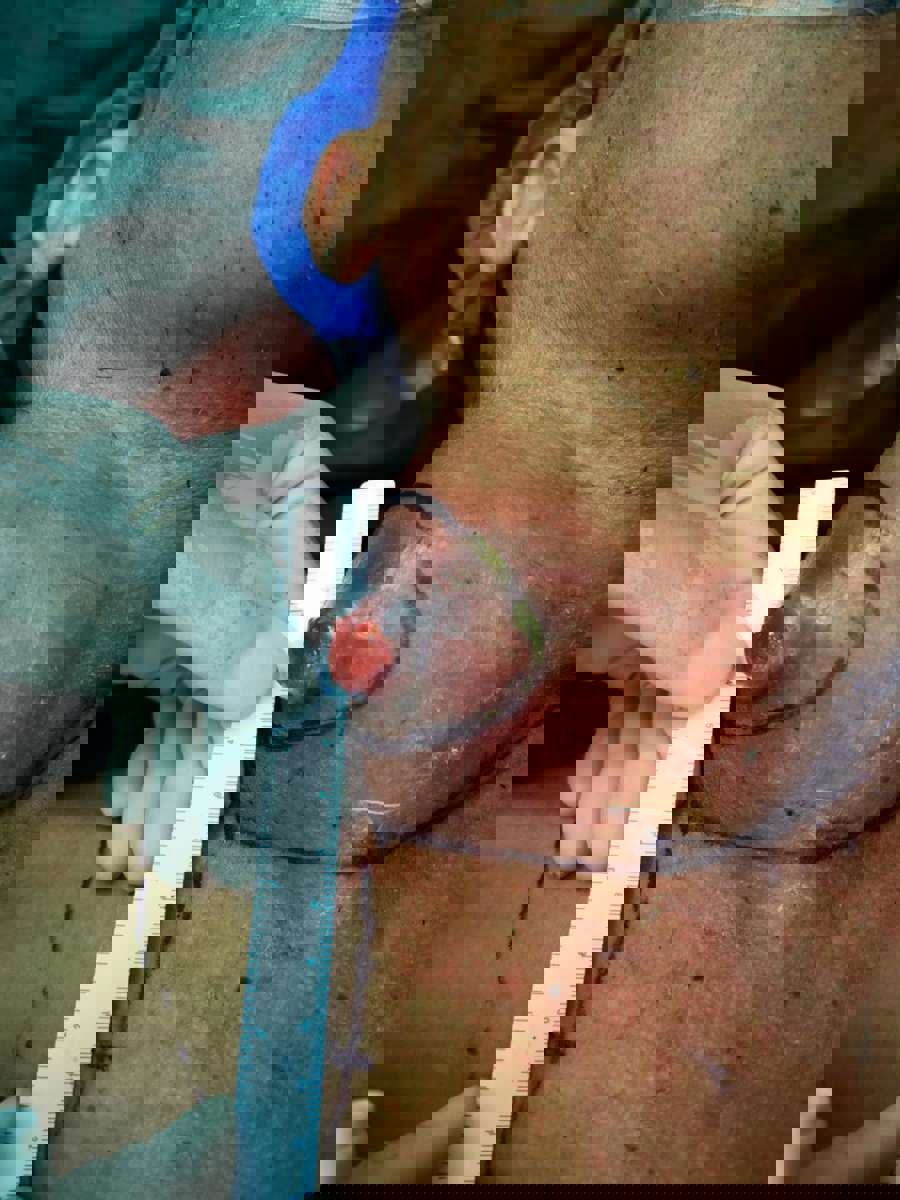 我院耳鼻喉头颈外科团队成功完成我院首例喉癌并颈部巨大淋巴结转移癌手术