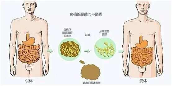 粪菌移植：汝之粪便 他之良药