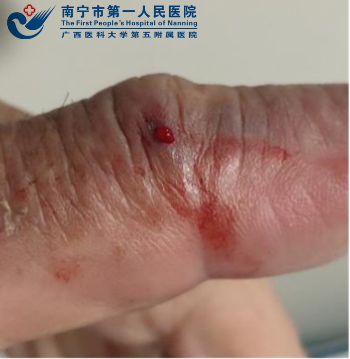 夏日当心蛇出没 ——被“肾亏蛇”咬伤致严重出血命悬一线 我院急诊科全力救治助患者转危为安