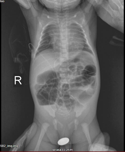 肛门闭锁伴直肠尿道瘘患儿顺利治愈出院