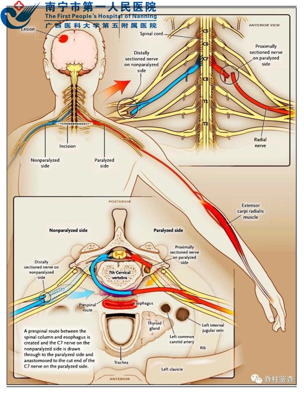 偏瘫治疗迎来新曙光