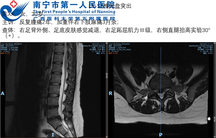 首例,南宁市第一人民医院脊柱骨病外科成功开展腰椎间盘纤维环缝合新技术