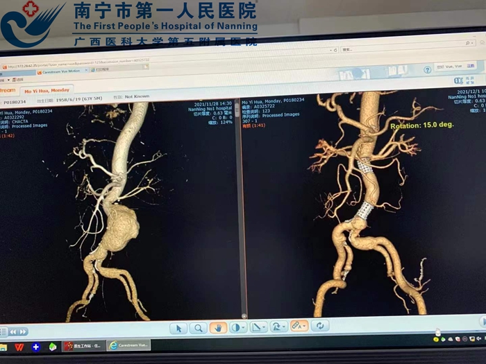 免缝合人工血管置换技术联合“杂交”技术助腹主动脉瘤破裂患者快速康复