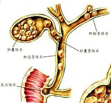 胆总管结石
