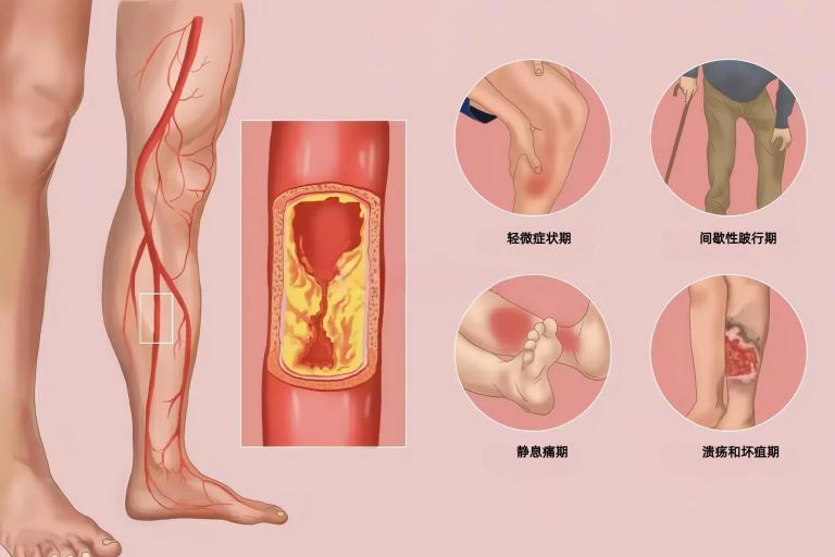 外周血管疾病宣传