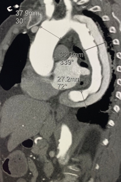 主动脉夹层及腹主动脉瘤技术