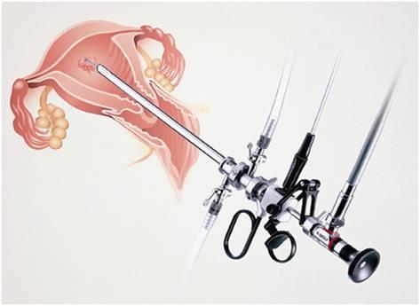 宫腔镜诊疗技术