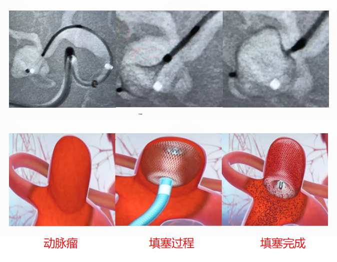 WEB™ 自膨式动脉瘤瘤内栓塞介入技术