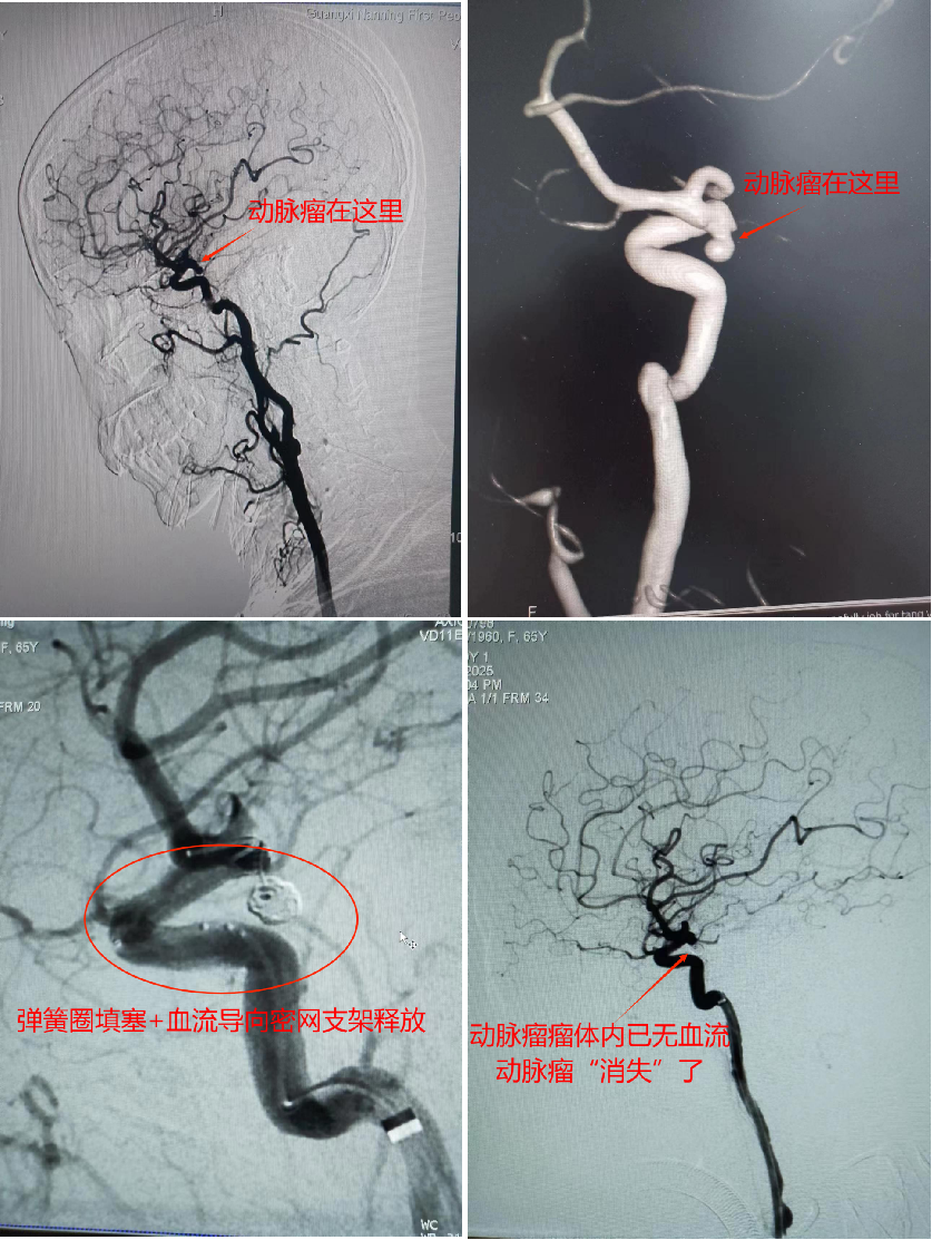 脑血管病及介入诊疗